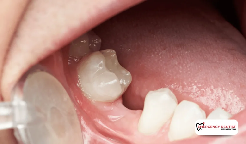 How Dry Sockets Develop