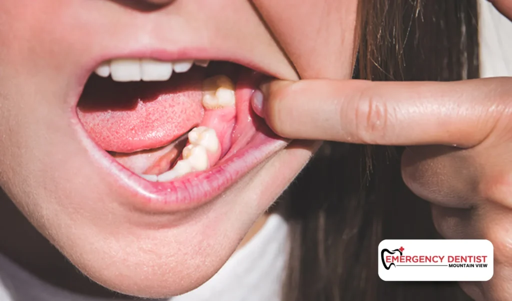 Tooth Pain After Tooth Pulled Is It Part of the Healing or a Dry Socket