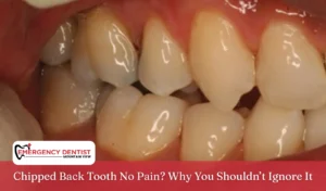 Chipped Back Tooth No Pain Why You Shouldn’t Ignore It