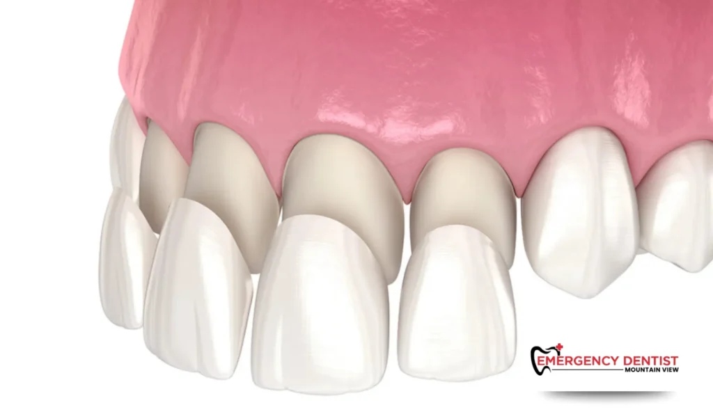 Dental Veneers or Porcelain Veneers