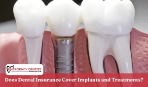 Does Dental Insurance Cover Implants and Treatments