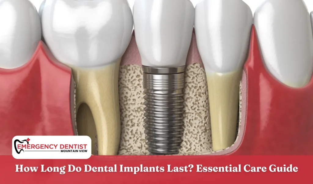 How Long Do Dental Implants Last Essential Care Guide