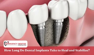 How Long Do Dental Implants Take to Heal and Stabilize