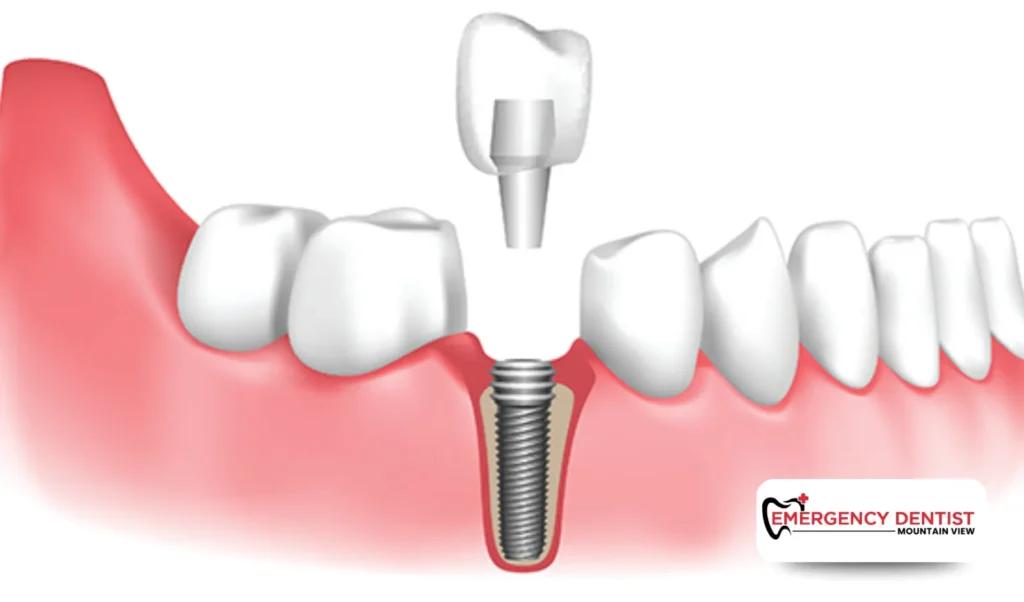 What Are Dental Implants