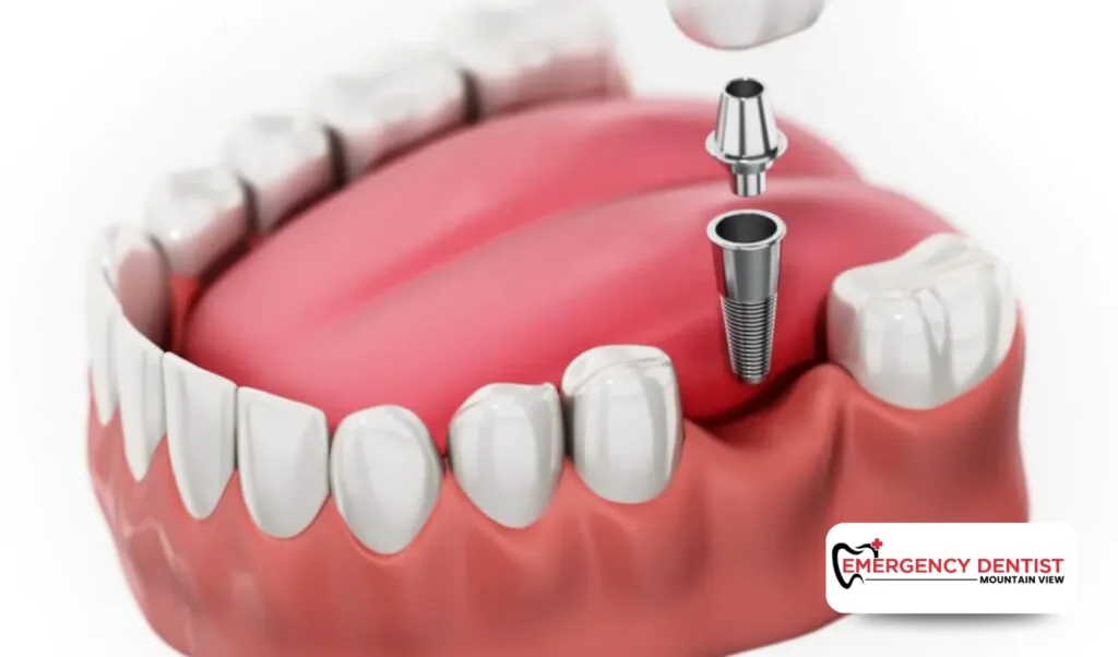 What Are Dental Implants and Why Are They Important