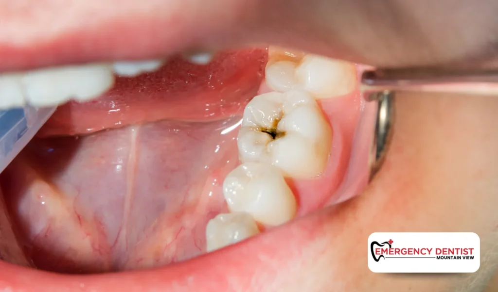 Common Causes of Dental Infections