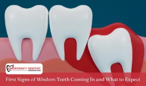 First Signs of Wisdom Teeth Coming In and What to Expect