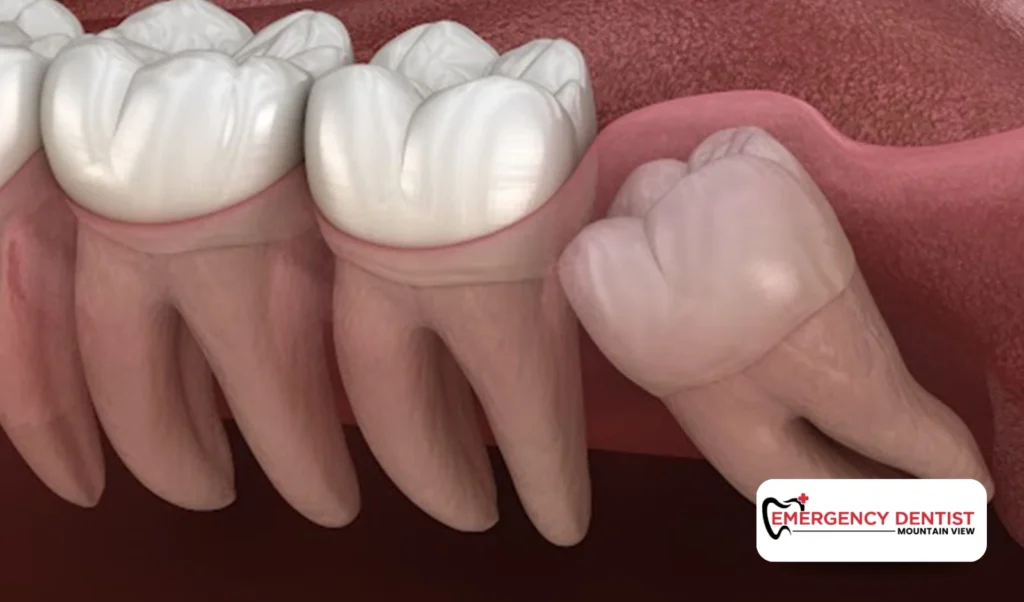 Understanding Wisdom Tooth Discomfort